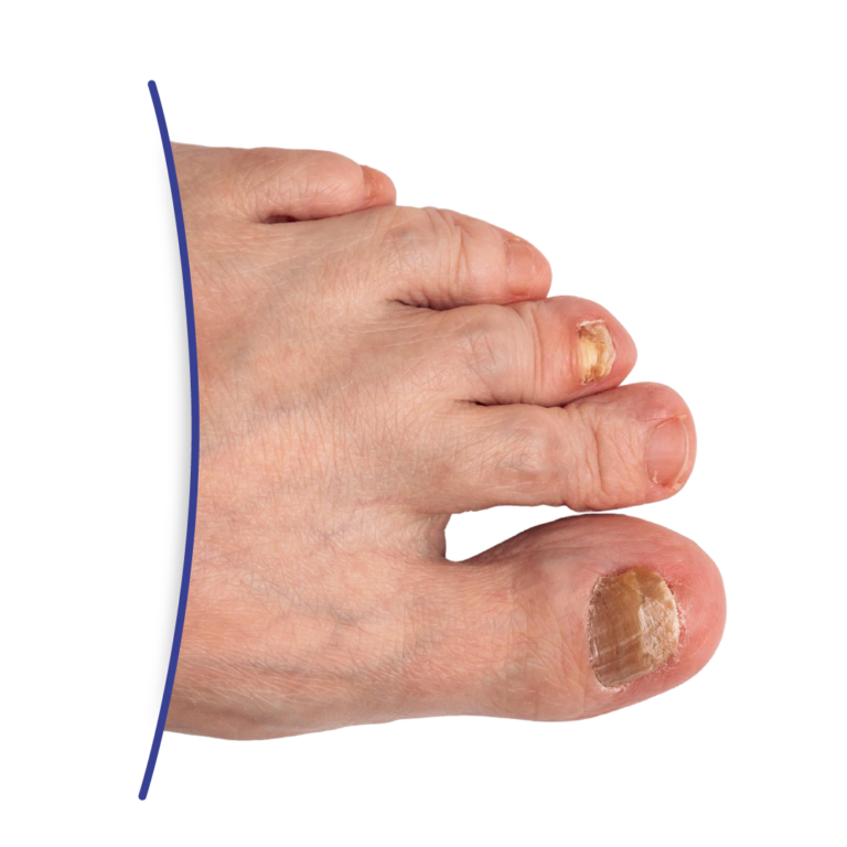 Onicomicosis en uñas. tratamiento para hongos en Quito