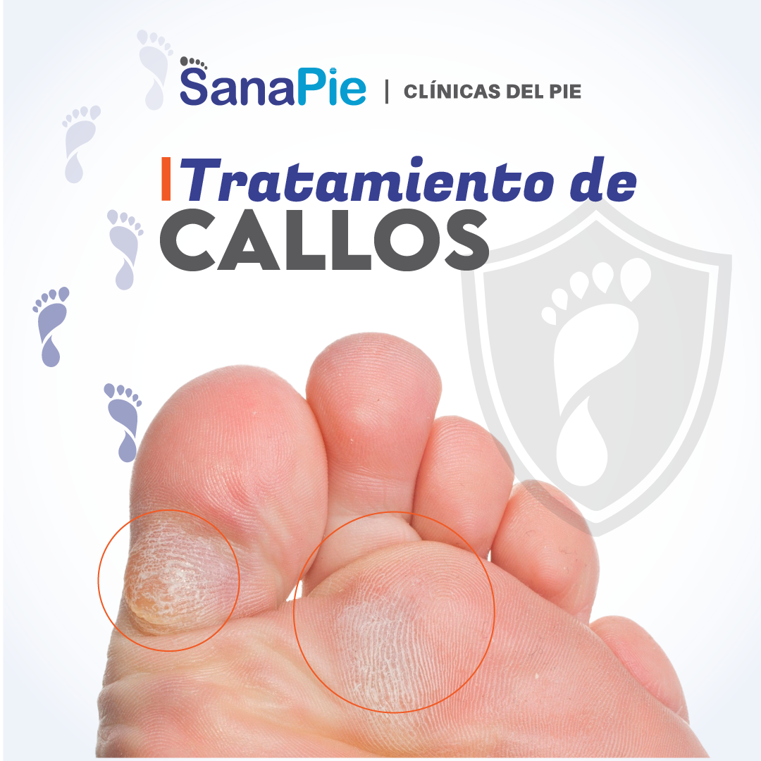 Tratamiento de callos
